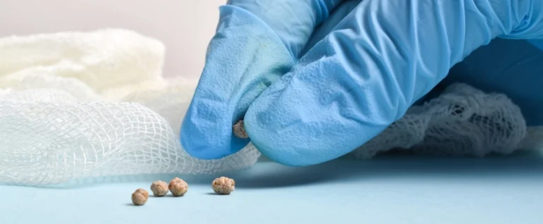 bladder stones removal surgery in navi mumbai