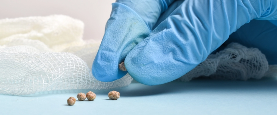 bladder stones removal surgery in navi mumbai