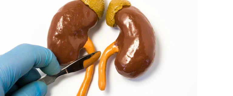 Understanding Ureteral Stones