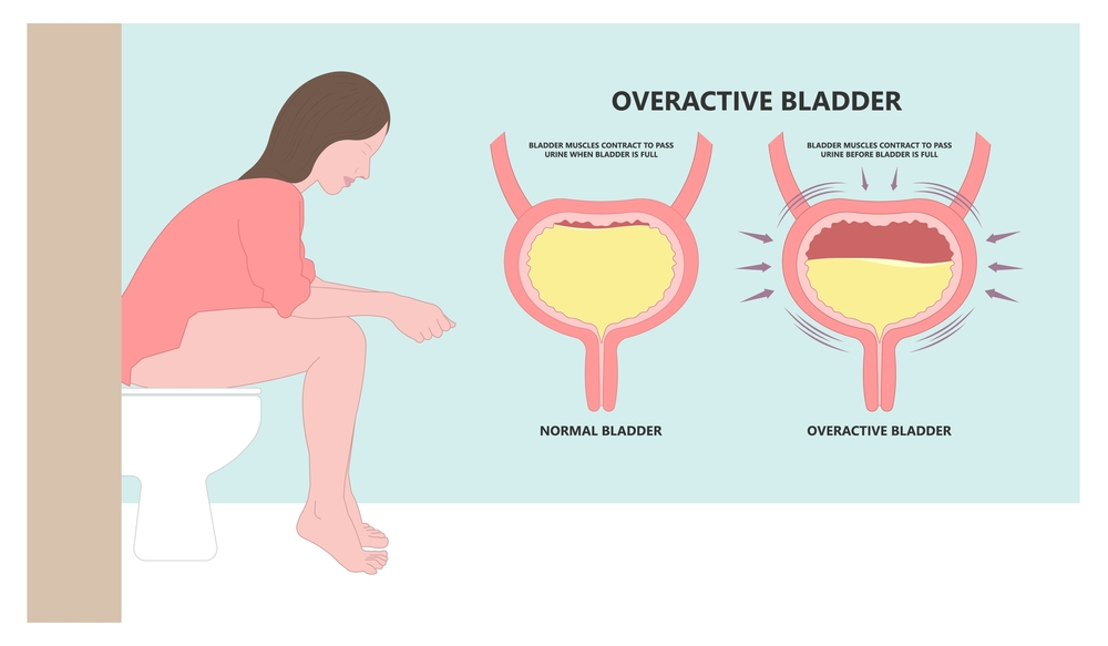 Overactive Bladder Images